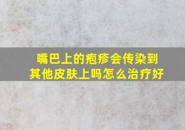 嘴巴上的疱疹会传染到其他皮肤上吗怎么治疗好