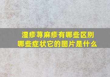 湿疹荨麻疹有哪些区别哪些症状它的图片是什么