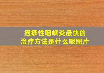 疱疹性咽峡炎最快的治疗方法是什么呢图片