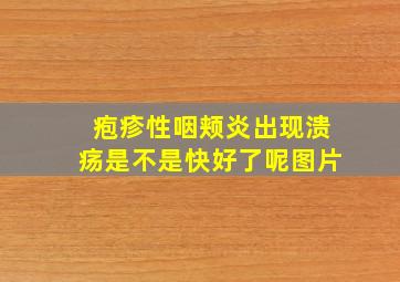 疱疹性咽颊炎出现溃疡是不是快好了呢图片