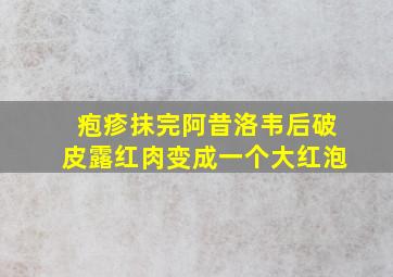 疱疹抹完阿昔洛韦后破皮露红肉变成一个大红泡