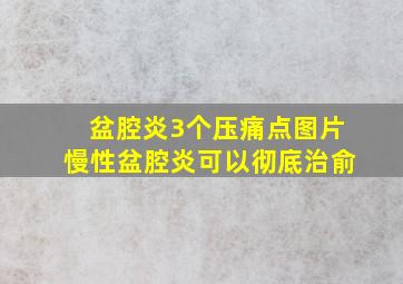 盆腔炎3个压痛点图片慢性盆腔炎可以彻底治俞