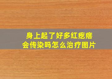 身上起了好多红疙瘩会传染吗怎么治疗图片